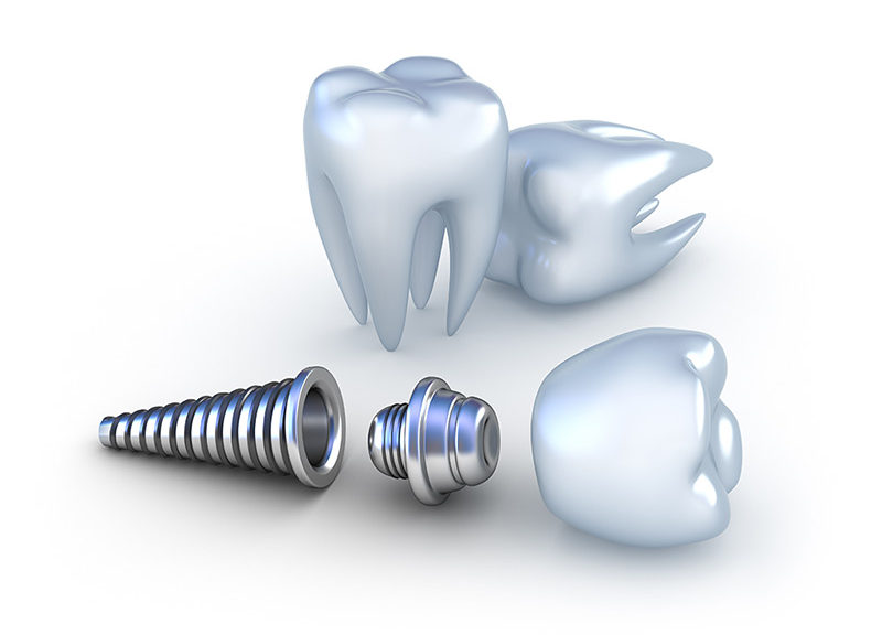 applications of titanium in dental implants